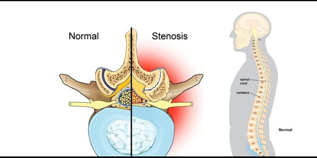 Image showing compared image of normal state and stenosis state of spine.