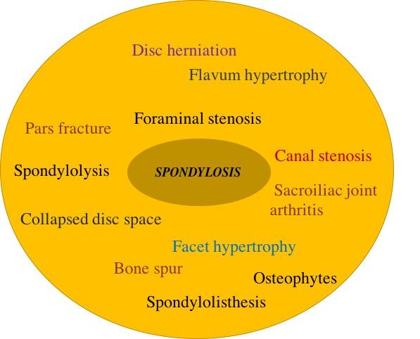 Infographic of Lumbar Spondylosis.
