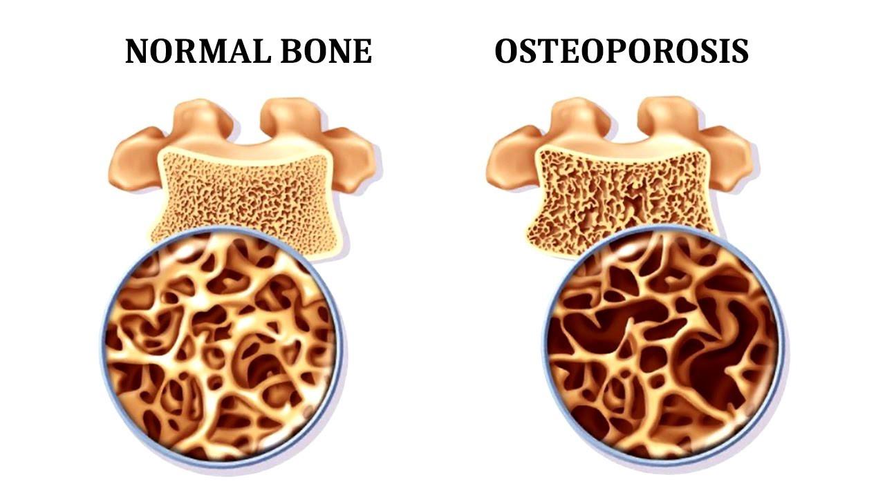 The image displays a comparison of the normal bone and osteoporosis-affected bone.