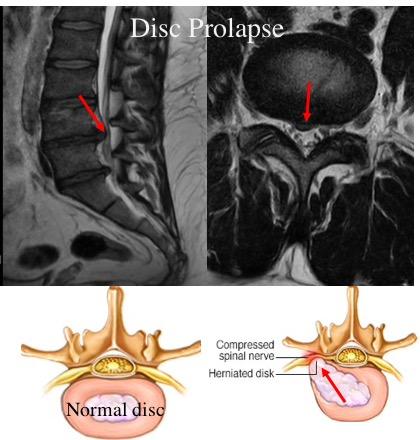 Images showing disc prolapse, normal disc & herniated disc.