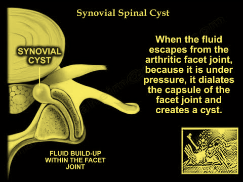 A Synovial spinal cyst is shown in the image.