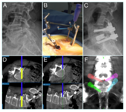 The collage of surgery pictures of MIS-TLIF for lumbar spondylolisthesis.