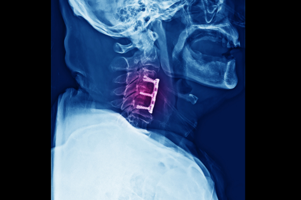 A spine X-ray image of the post-cervical disc surgery.