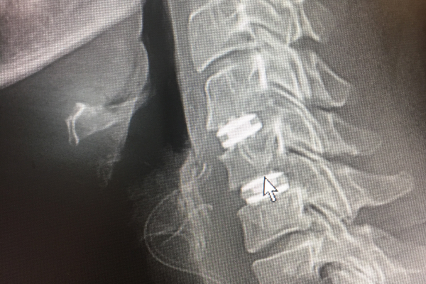 The medical image after the anterior cervical discectomy and fusion treatment in the spine.