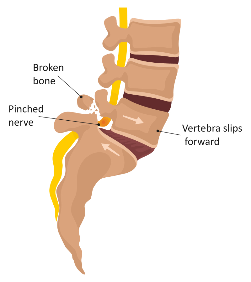 Image illustration of Lumbar spine with parts labelled.
