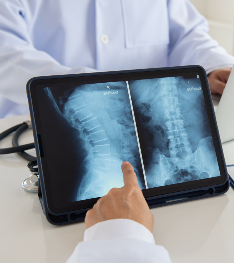 A doctor analyzes the digital x-ray of a patient for lumbar disc prolapse treatment.
