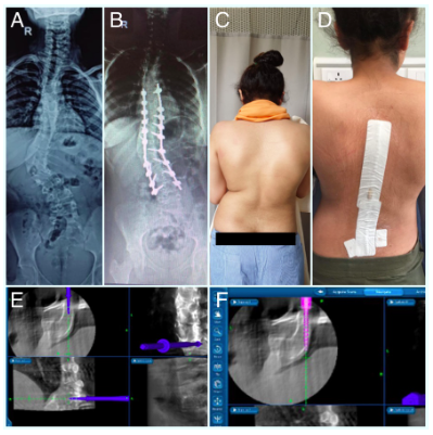 The collage of pre and post-surgery pictures for Spinal deformity correction.