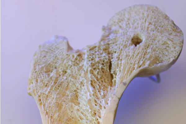 Image of a bone with osteoporosis.