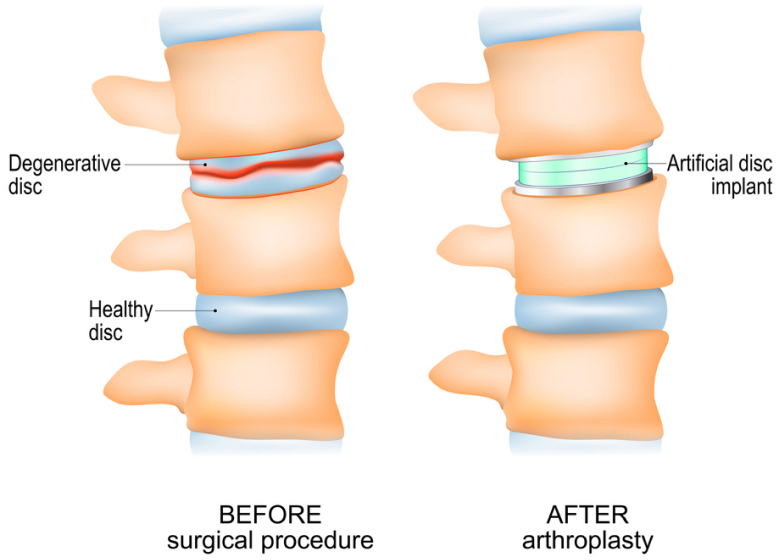 The pre and post-surgical images of the artificial cervical disc replacement.