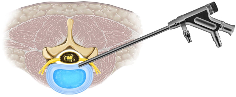 A pictorial representation of the transforaminal endoscopic lumbar discectomy procedure.