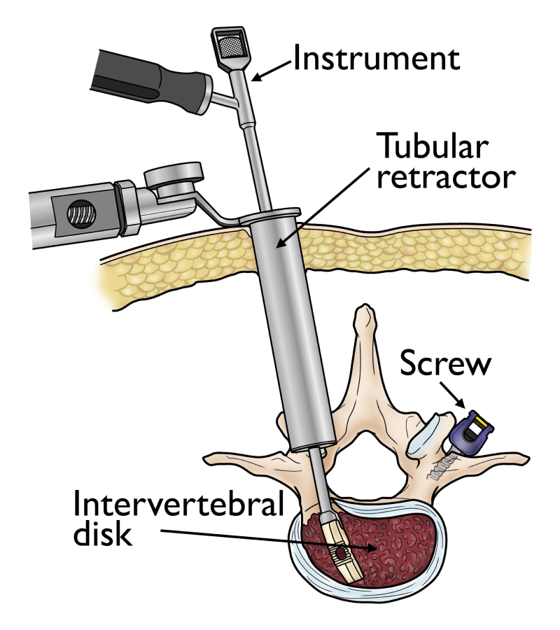 The image illustration of the minimally invasive lumbar fusion surgery.