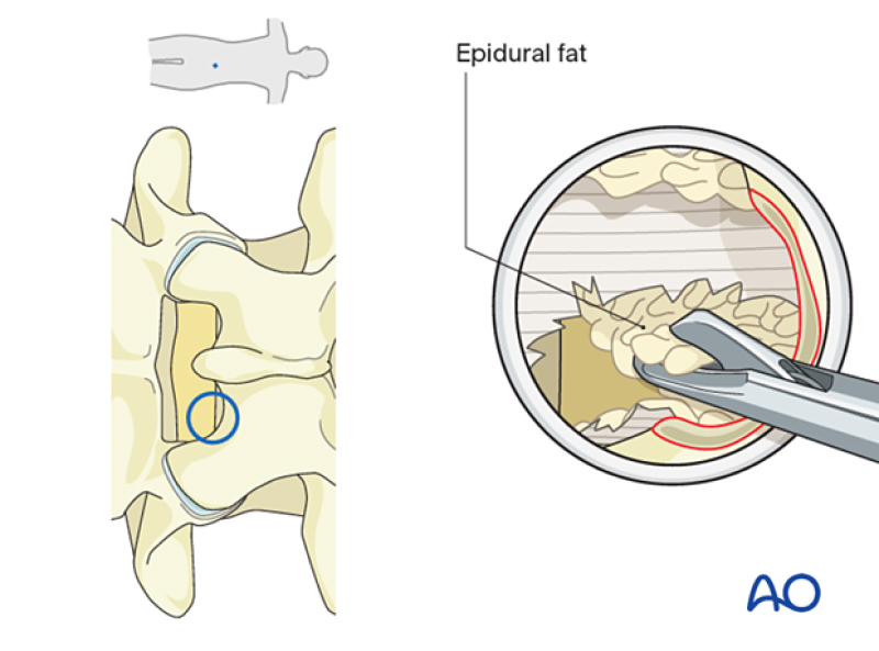 The image illustrates the interlaminar endoscopic lumbar discectomy procedure.