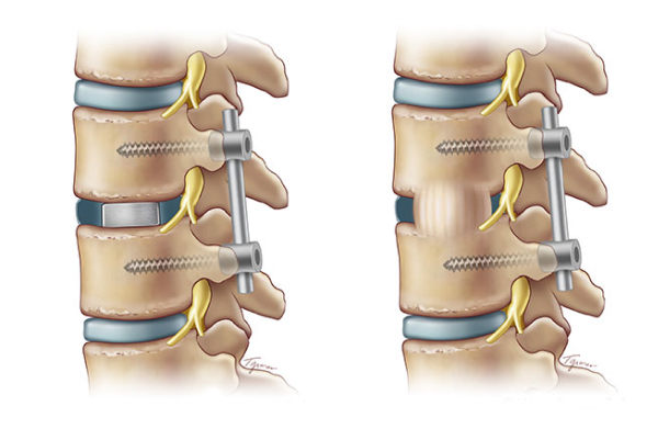 The spine image of the post-spinal fusion treatment with screws and rod.